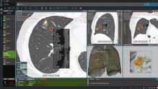 Coreline Soft's flagship product, AVIEW LCS, an AI-powered automatic pulmonary nodule analysis solution