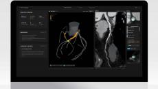 Artrya Salix AI decision support tool for diagnosing coronary heart disease