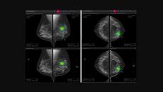 A sample scan analysis of Lunit INSIGHT DBT